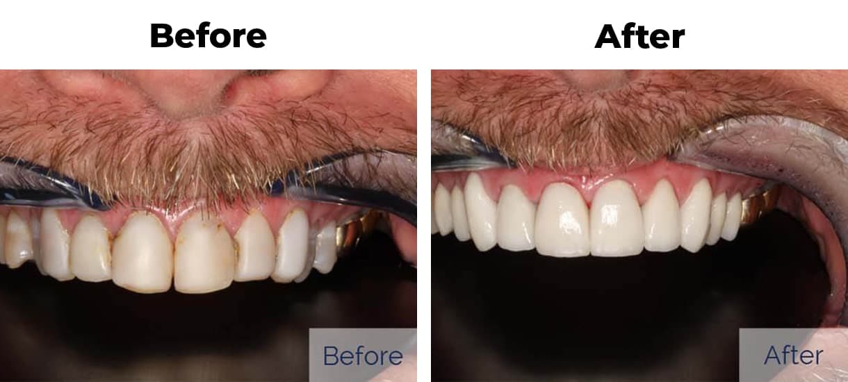 Patient before and after reshaping porcelain veneers