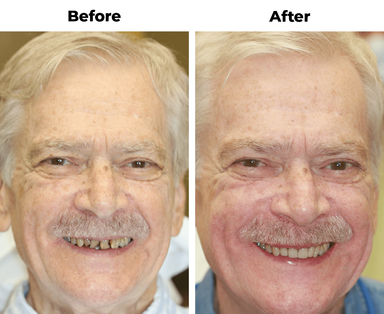 Patient before and after smile makeover