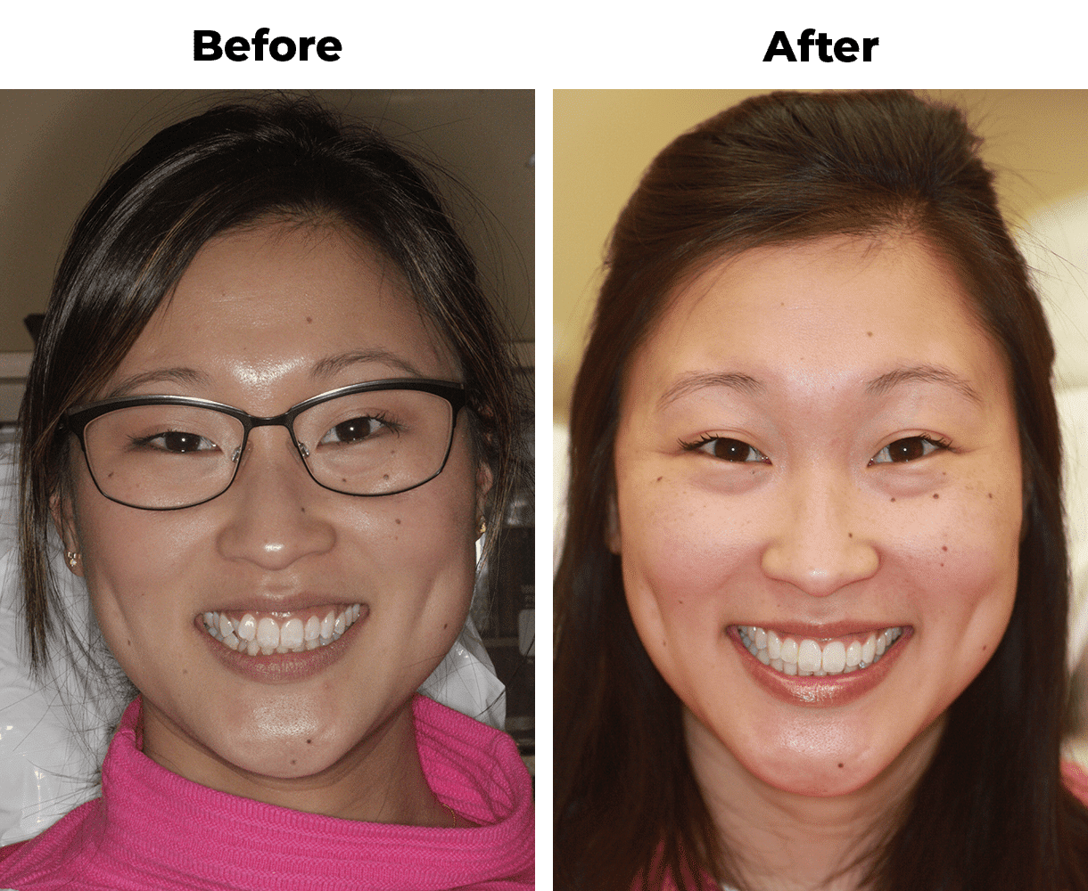 Patient before and after teeth alignment orthodontics