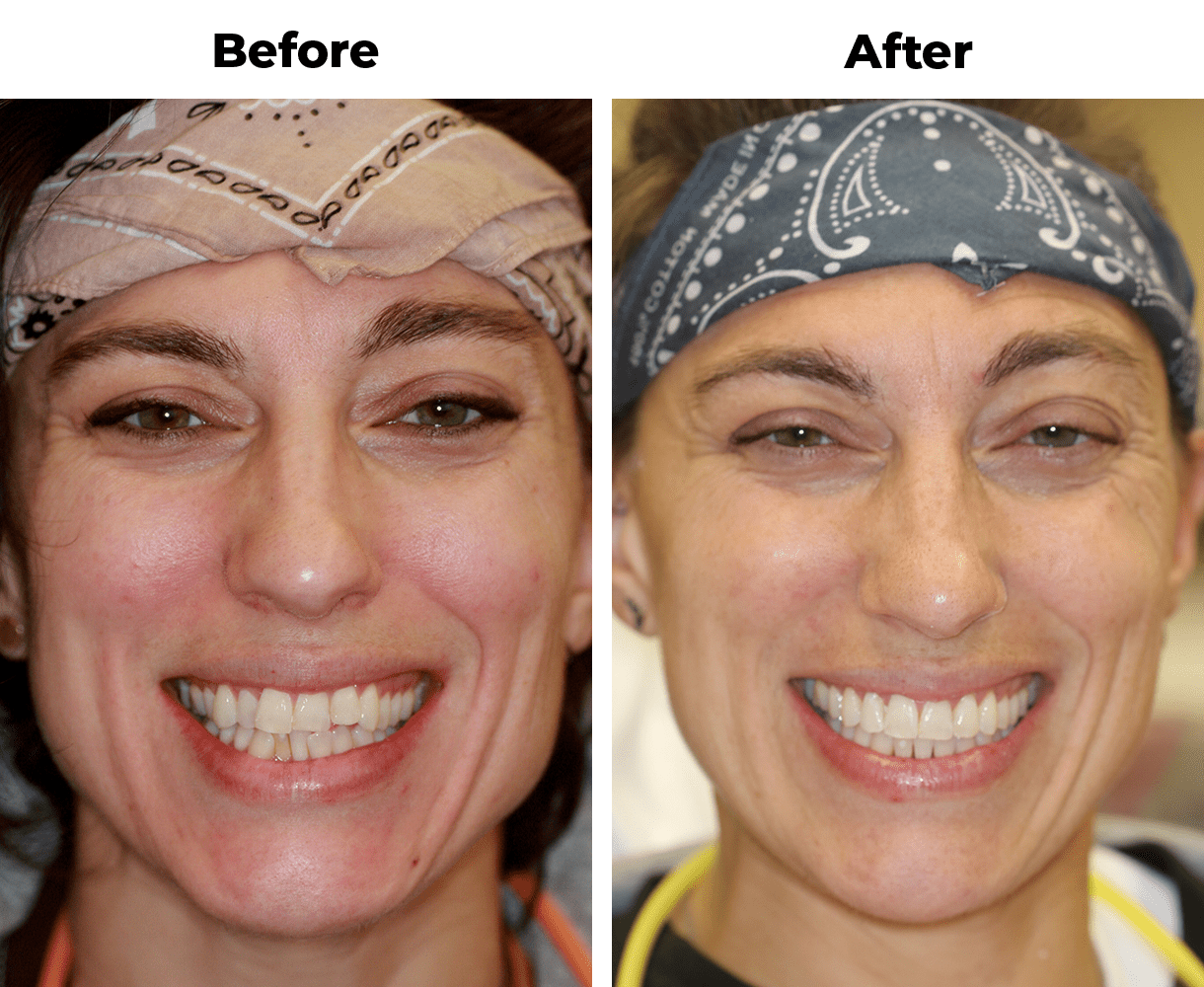 Patient before and after teeth straightening invisalign