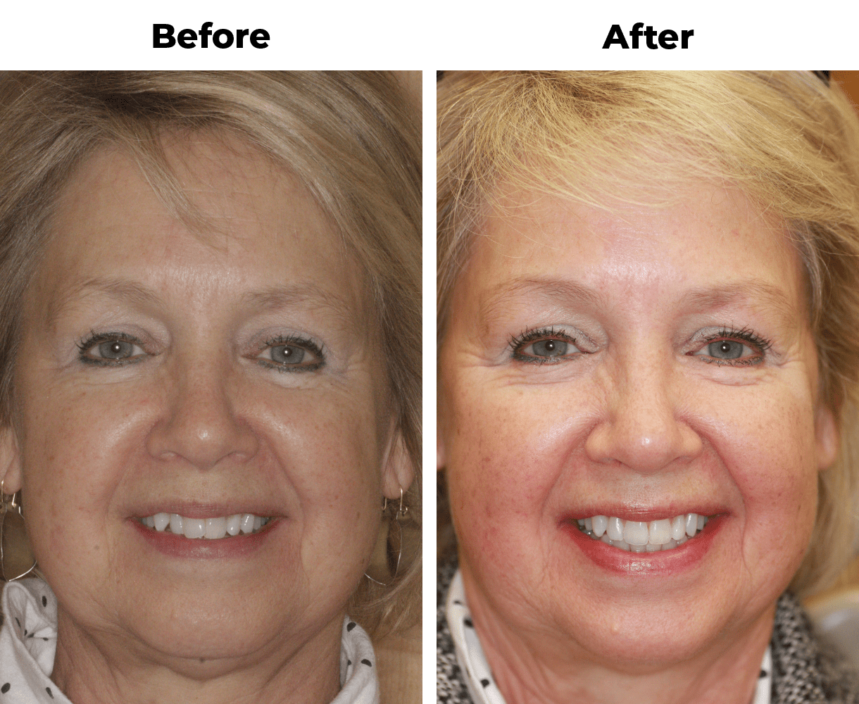 Patient before and after teeth straightening orthodontics