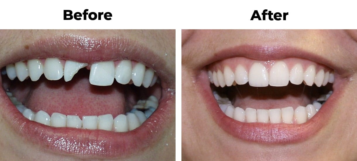 Patient before and after trauma porcelain crown