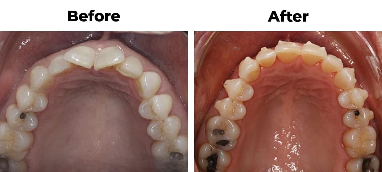 Patient before and after upper overcrowding invisalign