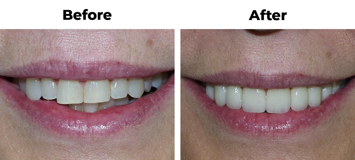 Patient before and after worn discolored teeth porcelain veneers