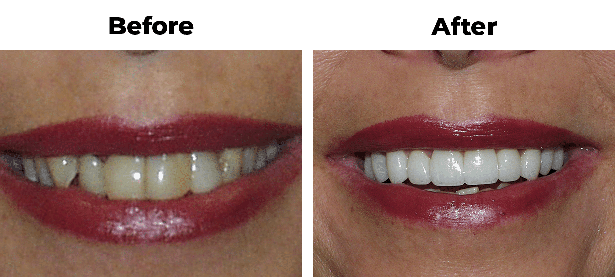 Patient before and after yellow teeth porcelain veneers