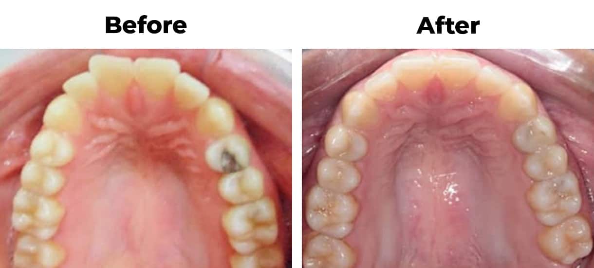 Protruding front teeth invisalign before and after treatment