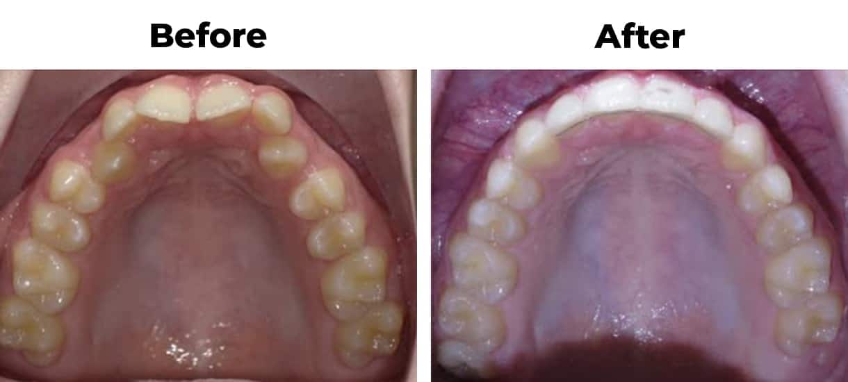 Protruding overcrowded invisalign before and after treatment