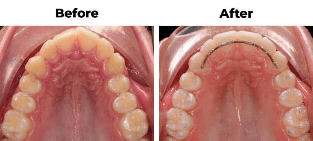 Rotated Narrow Arch invisalign before and after treatment