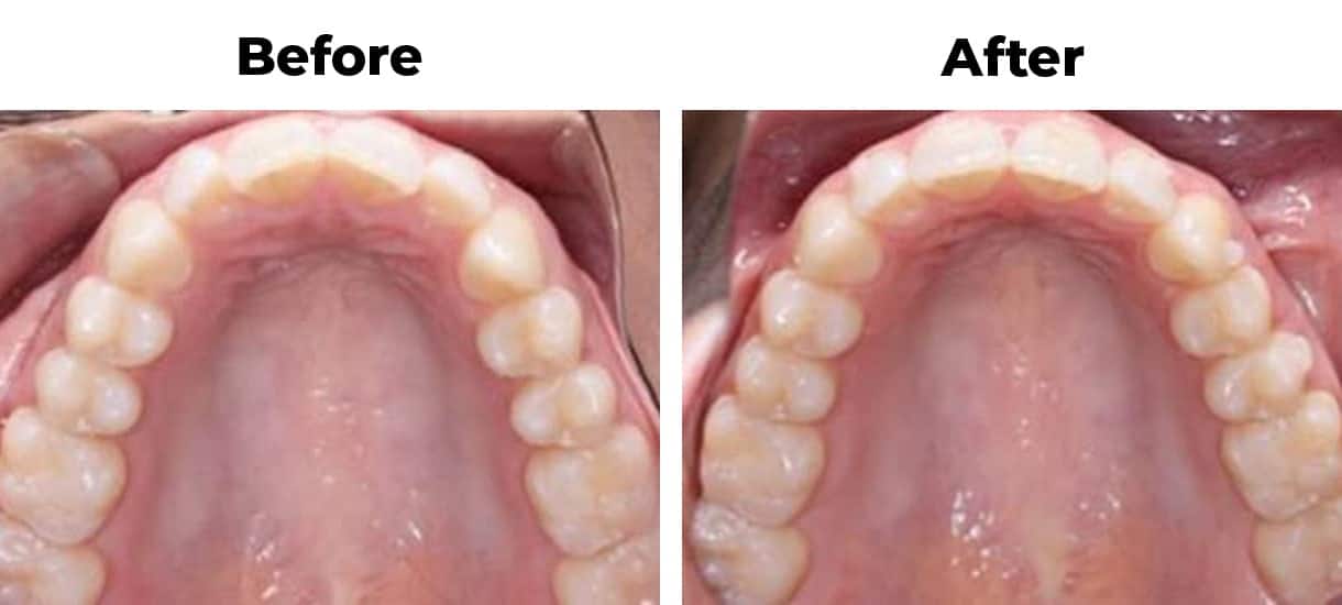 Rotated front teeth before and after treatment