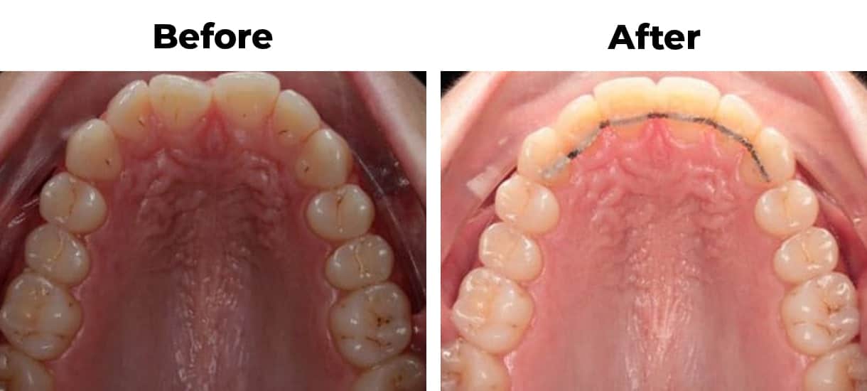 Rotated overcrowding invisalign before and after treatment