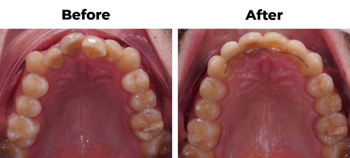 Rotated overcrowding overlapping invisalign before and after treatment