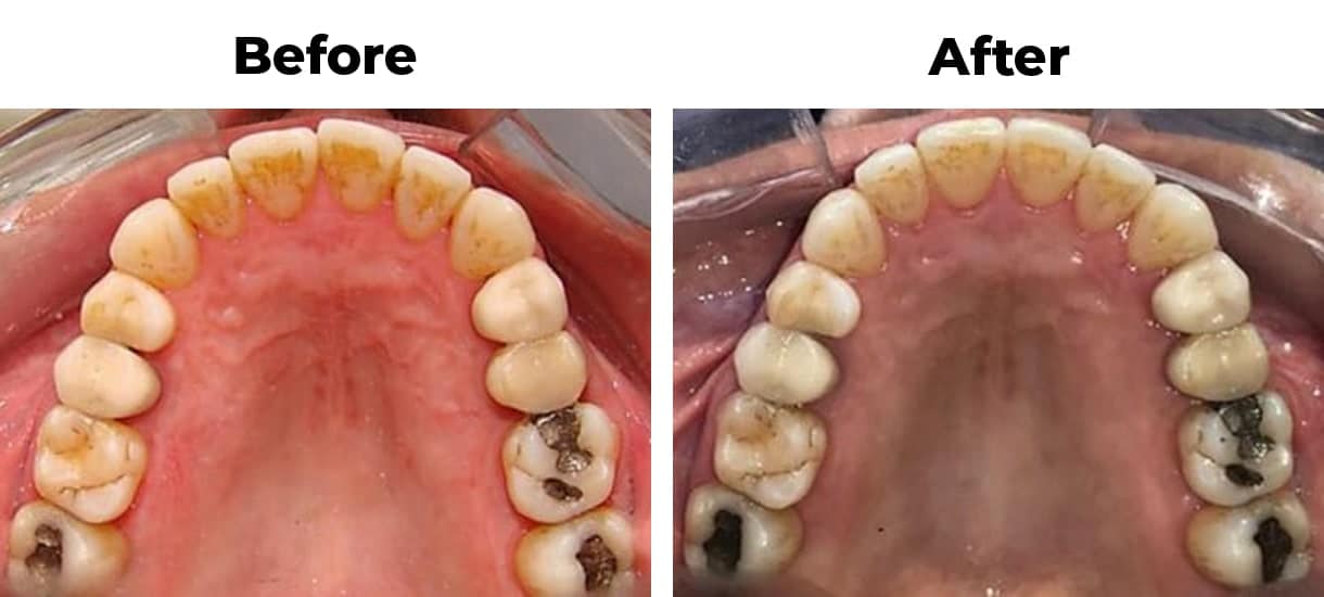 Rotating front tooth invisalign before and after treatment