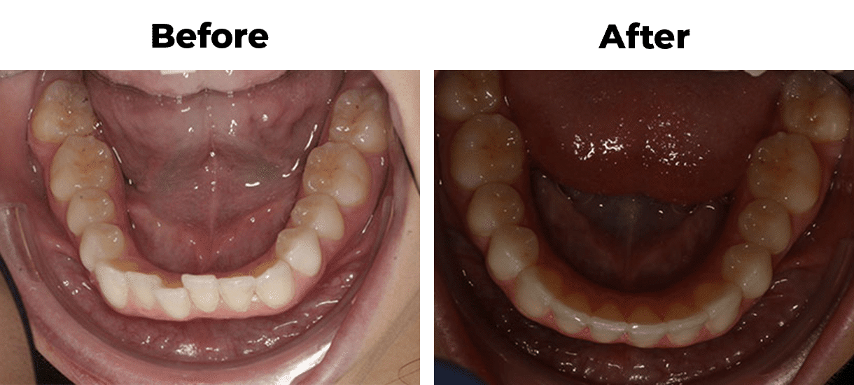 Teeth straightening with invisalign before and after treatment