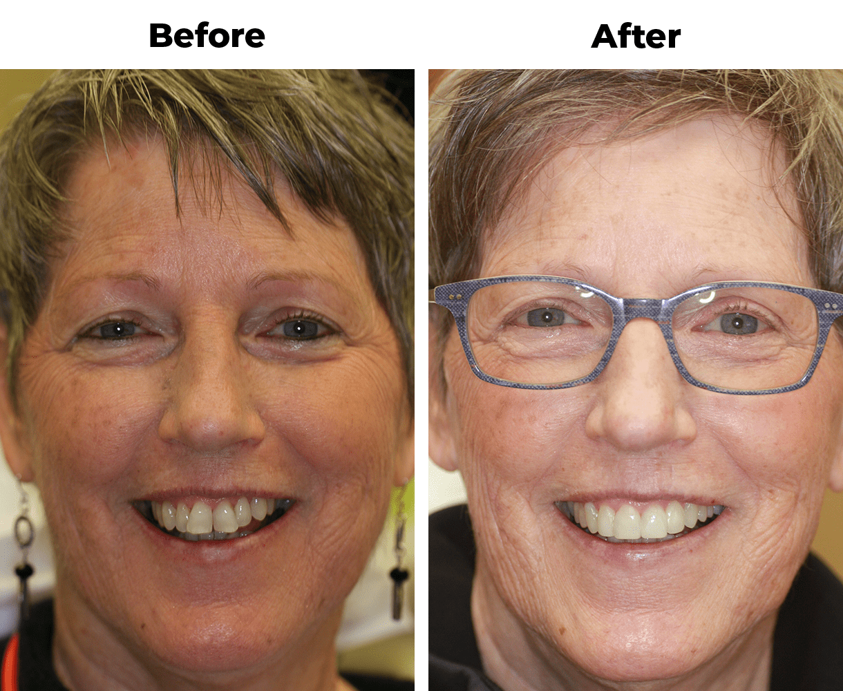 crowded teeth before and after invisalign treatment