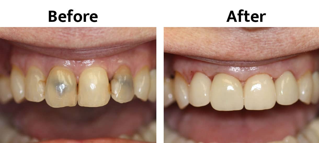 patient smile before and after