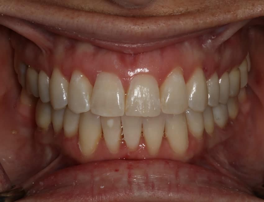 patient's smile up close after treatment