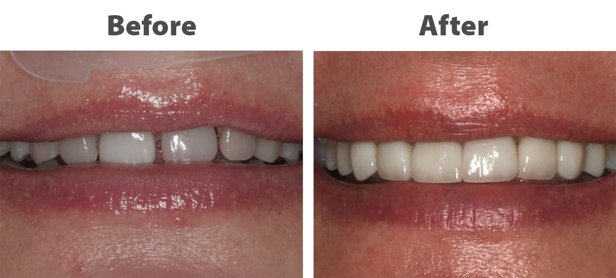 before and after images of a patient's smile