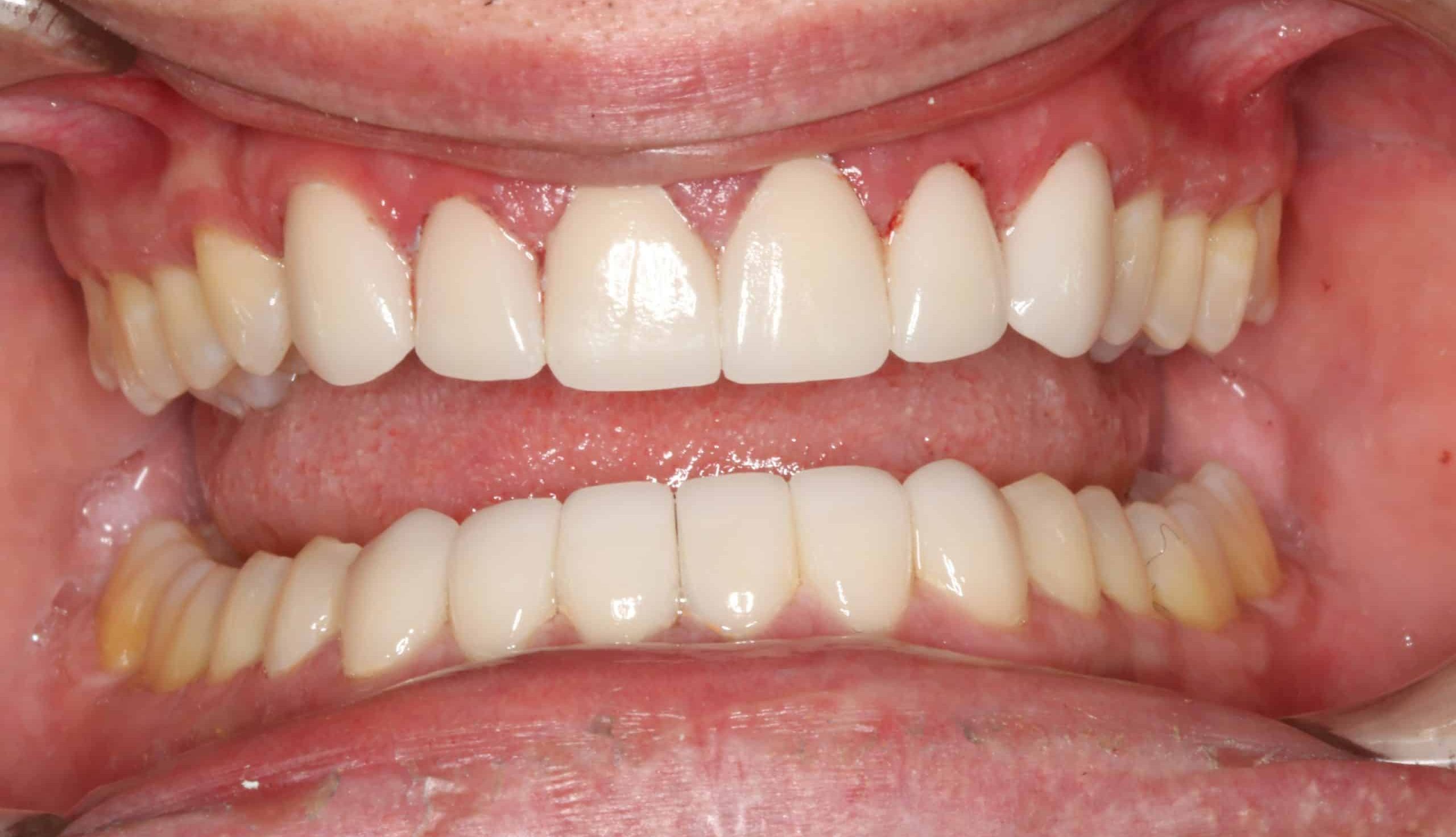 new, straighter teeth thanks to Invisalign and veneers