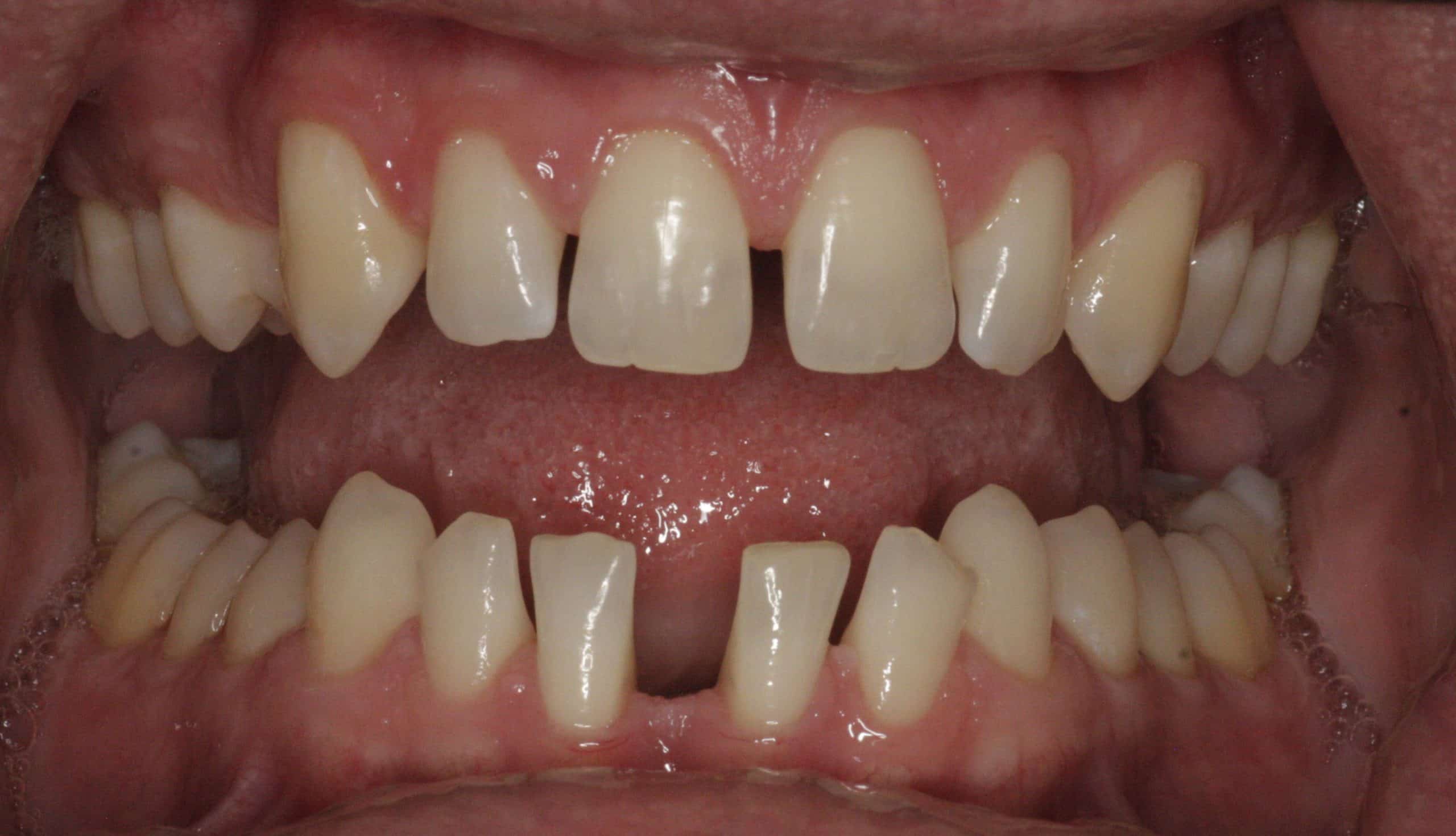 upclose image of misaligned teeth