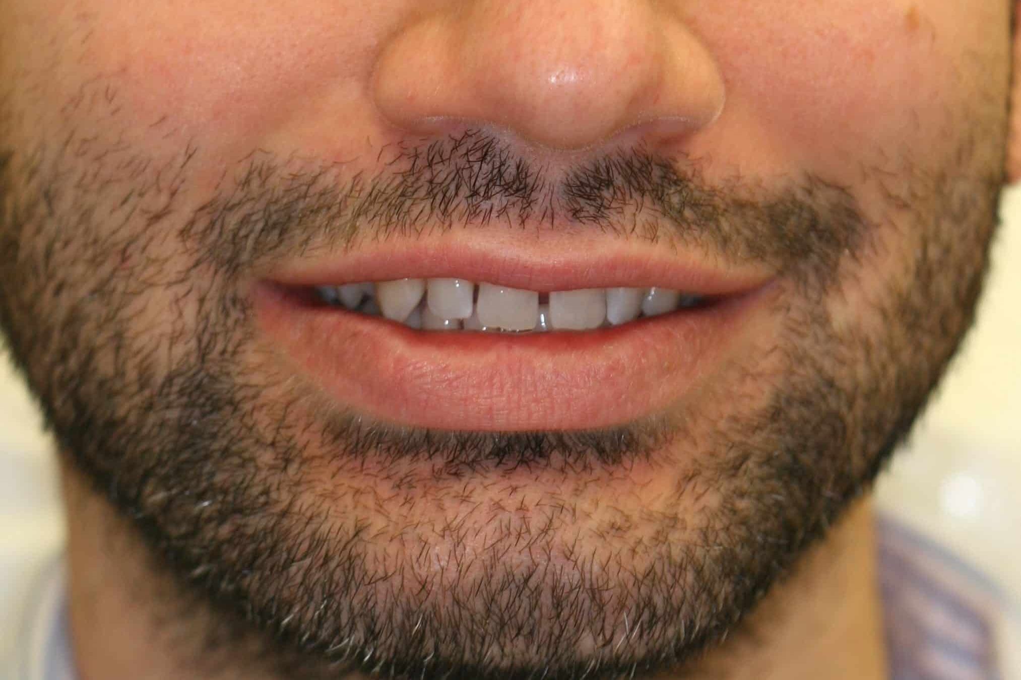 close up image of teeth showing gap in the front teeth