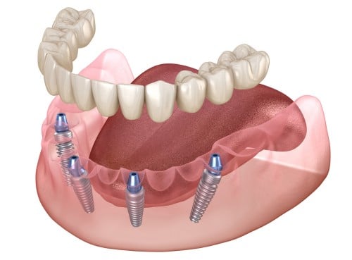 Dental implant diagram showing four implants embedded in the lower jawbone with a set of replacement teeth above them.